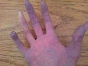 Raynaud's